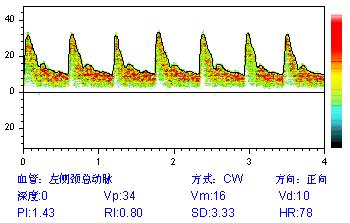 經顱多普勒報告中間頻譜圖含義.jpg