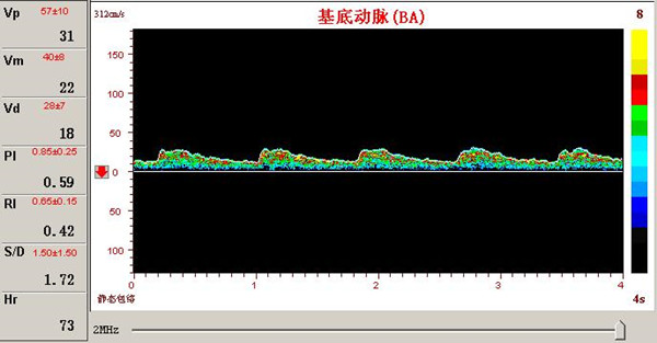 超聲經顱多普勒基底動脈供血不足頻譜圖.jpg