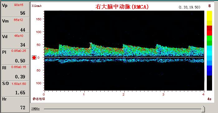 超聲經顱多普勒腦血管擴張頻譜圖.jpg